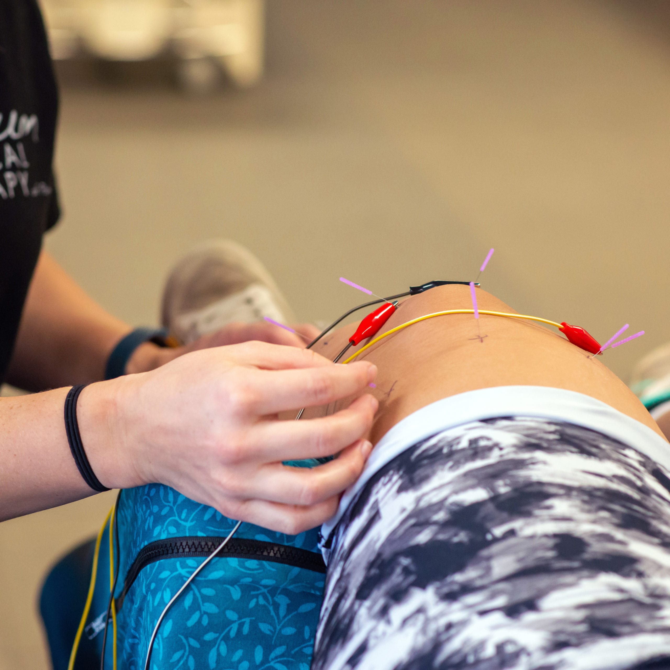 What You Need to Know About Dry Needling with Electrical Stimulation, Orthopedic Blog